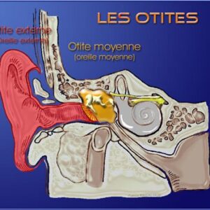 Otites Moyennes Aiguës
