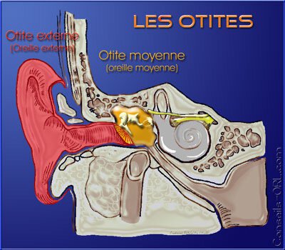 Otites Moyennes Aiguës 1 Otites Moyennes Aiguës