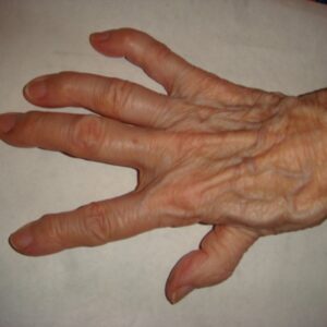 L’arthrose (1/2)